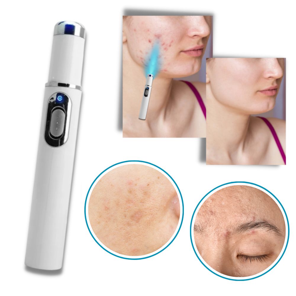 DermaPure | Draagbare Lasertherapie voor een Stralende Huid