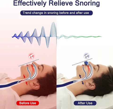 Emeja | Micro CPAP Anti-Snurkapparaat | Maskervrije Slaapapneu Behandeling