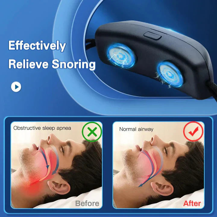 Slim Anti-Snurkapparaat EMS Puls Stop Snurken Draagbaar Comfortabel Slaap Goed Stop Snurken Gezondheidszorg Slaap Apneu Hulp USB