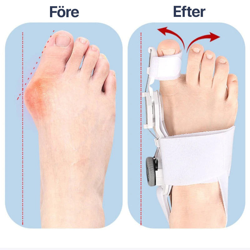 Tenencorrector voor Hallux Valgus met Verstelbare Ondersteuning